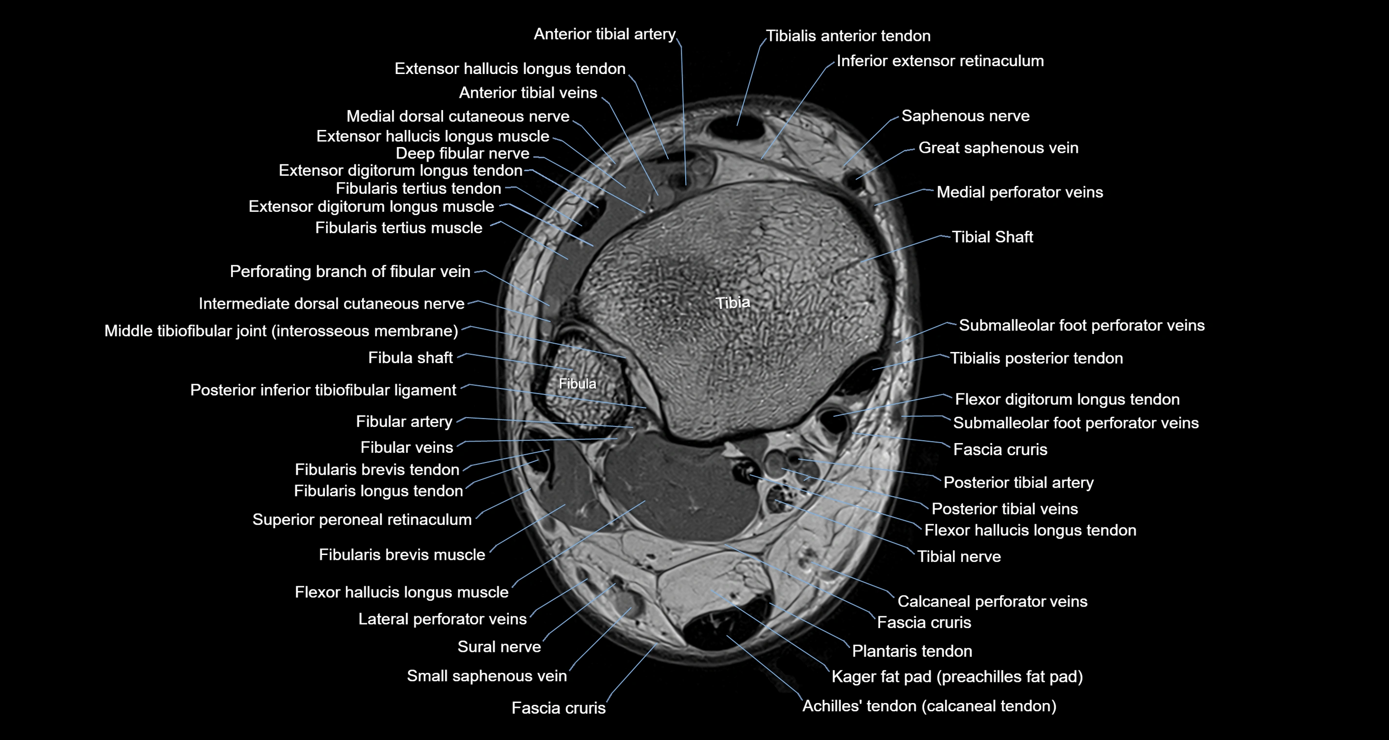 Ankle axial anatomy 3T MRI images -img-10001-00008.webp